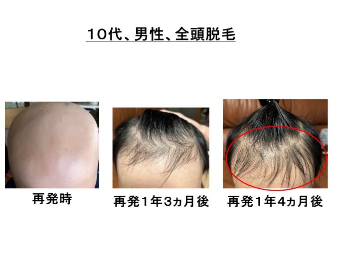 円形脱毛症　病院